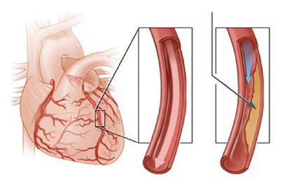 coronary-angiography