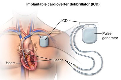 icd-implantation-specialist